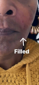 Facial Fillers Before and After Pictures in Buffalo, NY