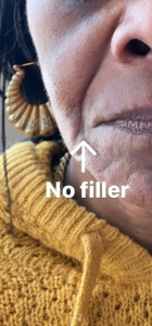 Facial Fillers Before and After Pictures in Buffalo, NY