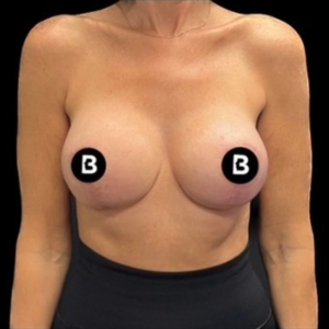 Breast Augmentation Before and After Pictures in Buffalo, NY