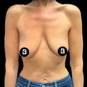 Breast Augmentation Before and After Pictures in Buffalo, NY