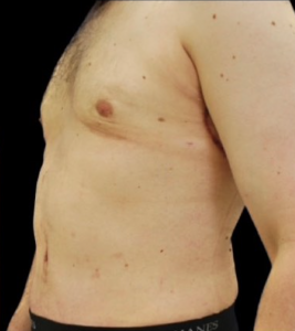 Abdominoplasty (Tummy Tuck) Before and After Pictures in Buffalo, NY