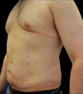 Abdominoplasty (Tummy Tuck) Before and After Pictures in Buffalo, NY