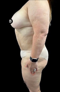 Mommy Makeover Before and After Pictures in Buffalo, NY