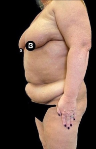 Mommy Makeover Before and After Pictures in Buffalo, NY