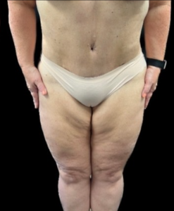 Abdominoplasty (Tummy Tuck) Before and After Pictures in Buffalo, NY