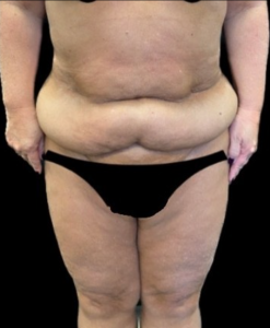 Abdominoplasty (Tummy Tuck) Before and After Pictures in Buffalo, NY