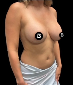 Breast Augmentation Before and After Pictures in Buffalo, NY