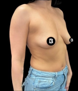 Breast Augmentation Before and After Pictures in Buffalo, NY