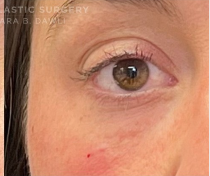 Tear Trough Fillers Before and After Pictures in Buffalo, NY