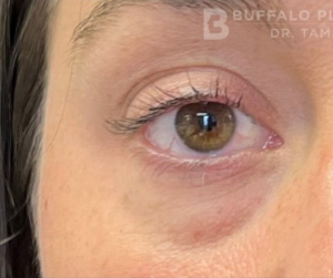 Tear Trough Fillers Before and After Pictures in Buffalo, NY