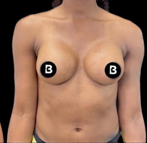 Breast Augmentation Before and After Pictures in Buffalo, NY