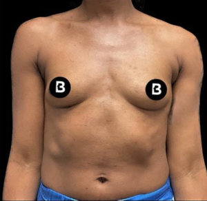 Breast Augmentation Before and After Pictures in Buffalo, NY