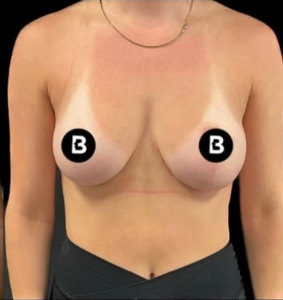 Breast Augmentation Before and After Pictures in Buffalo, NY