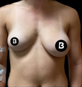 Breast Augmentation Before and After Pictures in Buffalo, NY