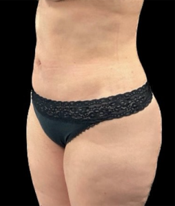 Abdominoplasty (Tummy Tuck) Before and After Pictures in Buffalo, NY