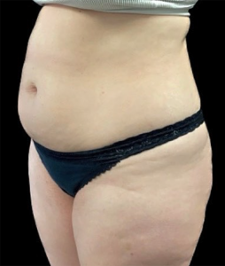 Abdominoplasty (Tummy Tuck) Before and After Pictures in Buffalo, NY