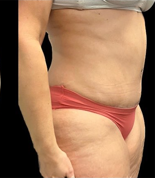 Abdominoplasty (Tummy Tuck) Before and After Pictures in Buffalo, NY