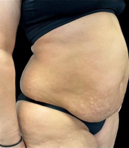 Abdominoplasty (Tummy Tuck) Before and After Pictures in Buffalo, NY