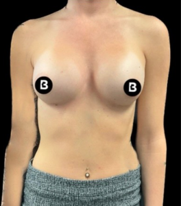 Breast Augmentation Before and After Pictures in Buffalo, NY