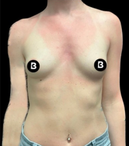 Breast Augmentation Before and After Pictures in Buffalo, NY