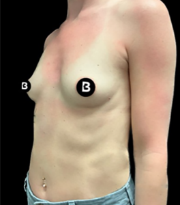 Breast Augmentation Before and After Pictures in Buffalo, NY