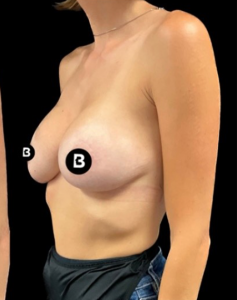 Breast Augmentation Before and After Pictures in Buffalo, NY