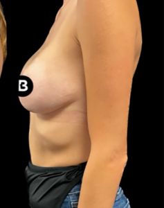 Breast Augmentation Before and After Pictures in Buffalo, NY