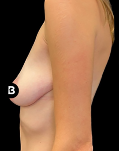Breast Augmentation Before and After Pictures in Buffalo, NY