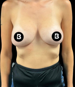 Breast Augmentation Before and After Pictures in Buffalo, NY