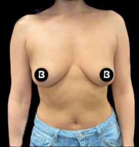 Breast Augmentation Before and After Pictures in Buffalo, NY