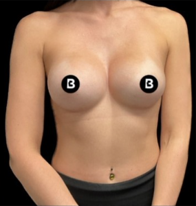 Breast Augmentation Before and After Pictures in Buffalo, NY