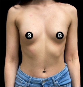 Breast Augmentation Before and After Pictures in Buffalo, NY