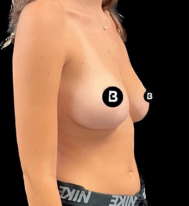 Breast Reduction Before and After Pictures in Buffalo, NY