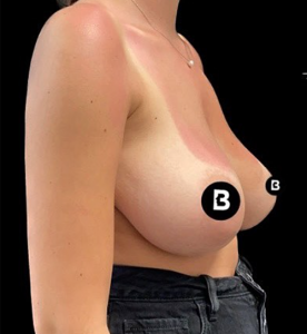 Breast Reduction Before and After Pictures in Buffalo, NY