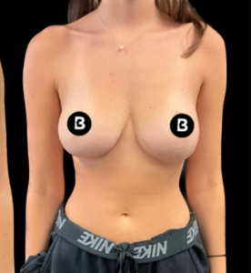 Breast Reduction Before and After Pictures in Buffalo, NY