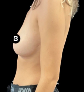 Breast Reduction Before and After Pictures in Buffalo, NY