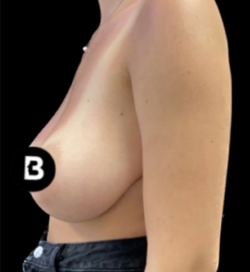 Breast Reduction Before and After Pictures in Buffalo, NY