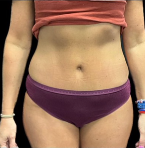 Abdominoplasty (Tummy Tuck) Before and After Pictures in Buffalo, NY