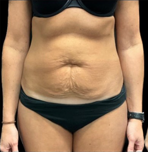 Abdominoplasty (Tummy Tuck) Before and After Pictures in Buffalo, NY