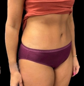 Abdominoplasty (Tummy Tuck) Before and After Pictures in Buffalo, NY