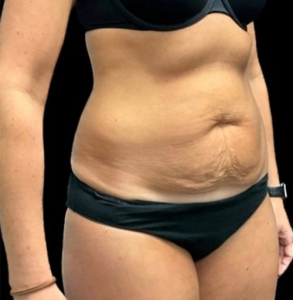 Abdominoplasty (Tummy Tuck) Before and After Pictures in Buffalo, NY