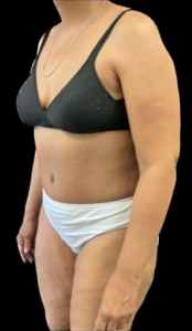 Abdominoplasty (Tummy Tuck) Before and After Pictures in Buffalo, NY