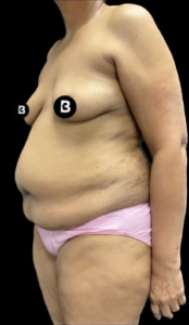 Abdominoplasty (Tummy Tuck) Before and After Pictures in Buffalo, NY