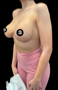 Breast Augmentation Before and After Pictures in Buffalo, NY