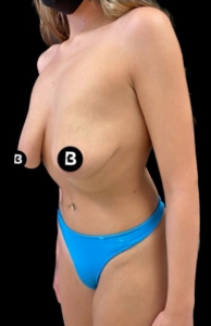 Breast Augmentation Before and After Pictures in Buffalo, NY