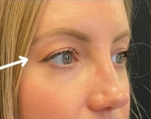 Blepharoplasty (Eyelid Surgery) Before and After Pictures in Buffalo, NY