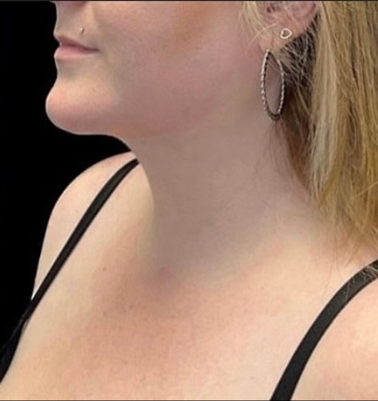 Chin Liposuction Before and After Pictures Buffalo, NY