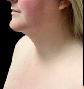 Chin Liposuction Before and After Pictures Buffalo, NY