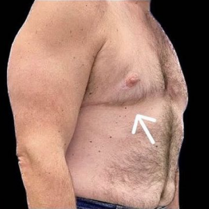 Gynecomastia (Male Chest Surgery) Before and After Pictures in Buffalo, NY