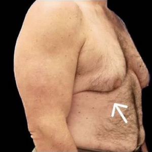 Gynecomastia (Male Chest Surgery) Before and After Pictures in Buffalo, NY